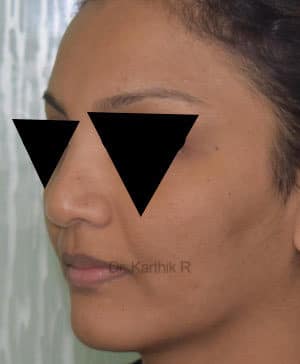 Rhinoplasty (Nose Corrections)