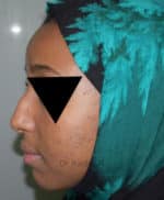 Rhinoplasty (Nose Corrections)