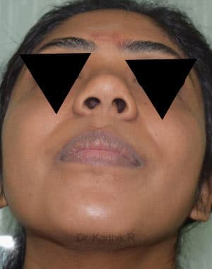 Rhinoplasty (Nose Corrections)