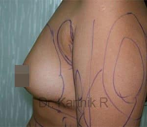 Breast Fat Fill (Breast Augmentation)