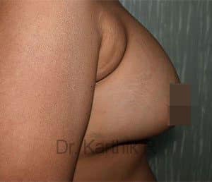 Breast Fat Fill (Breast Augmentation)