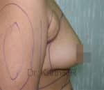 Breast Fat Fill (Breast Augmentation)