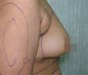 Breast Fat Fill (Breast Augmentation)