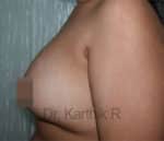 Breast Fat Fill (Breast Augmentation)