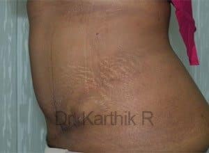 Tummy Tuck