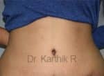 Tummy Tuck