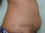 Tummy Tuck