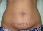 Tummy Tuck