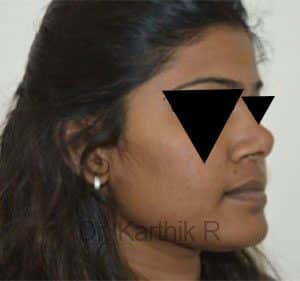 Rhinoplasty (Nose Corrections)