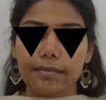 Rhinoplasty (Nose Corrections)