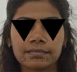 Rhinoplasty (Nose Corrections)