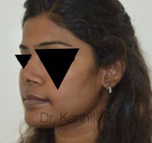 Rhinoplasty (Nose Corrections)
