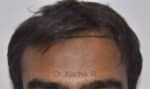 Hair Transplantation