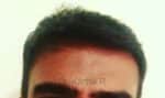 Hair Transplantation