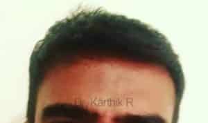 Hair Transplantation