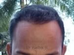 Hair Transplantation