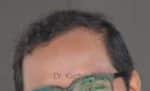 Hair Transplantation