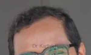 Hair Transplantation