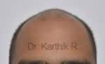 Hair Transplantation