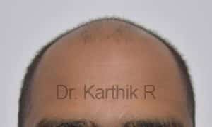 Hair Transplantation