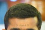 Hair Transplantation