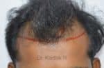 Hair Transplantation