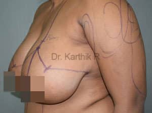 Breast Reduction and Breast Lift