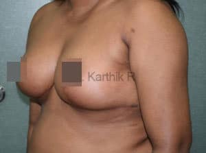 Breast Reduction and Breast Lift