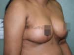 Breast Reduction and Breast Lift