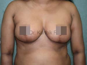 Breast Reduction and Breast Lift