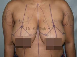 Breast Reduction and Breast Lift