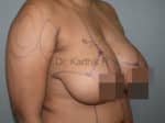 Breast Reduction and Breast Lift