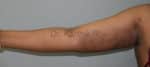 Liposuction Arms and Arm Tuck