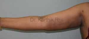 Liposuction Arms and Arm Tuck