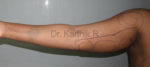 Liposuction Arms and Arm Tuck