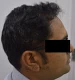 Hair Transplantation