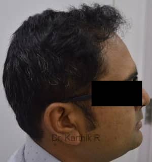 Hair Transplantation