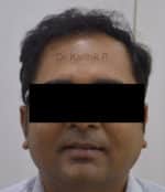 Hair Transplantation