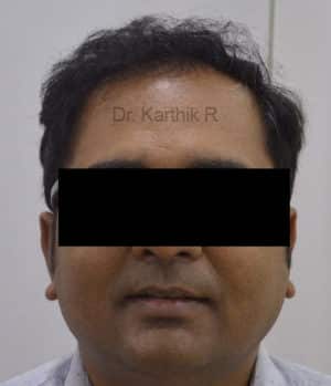Hair Transplantation
