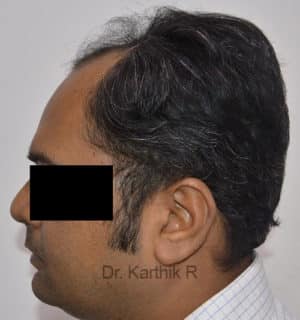 Hair Transplantation