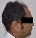 Hair Transplantation