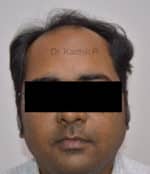 Hair Transplantation