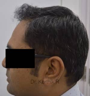 Hair Transplantation