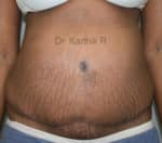 Tummy Tuck