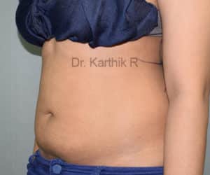 Liposuction Tummy and Back