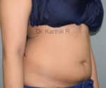 Liposuction Tummy and Back