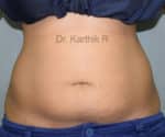 Liposuction Tummy and Back