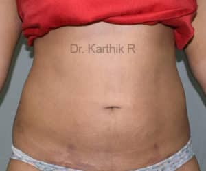 Liposuction Tummy and Back