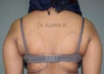 Liposuction Tummy and Back