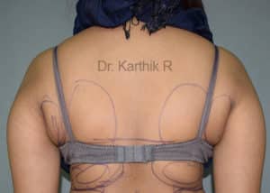 Liposuction Tummy and Back